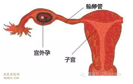 天津津南宫外孕常识大全