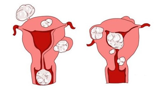 天津津南红山区出现子宫肌瘤，可以不治疗吗?