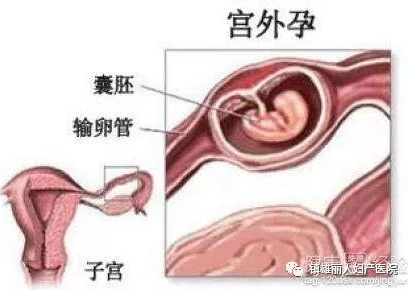 天津津南诱发宫外孕的常见原因有哪些